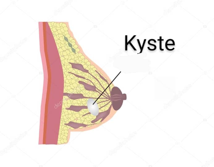 kyste o