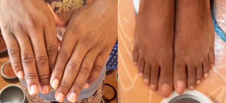 origine depigmentation